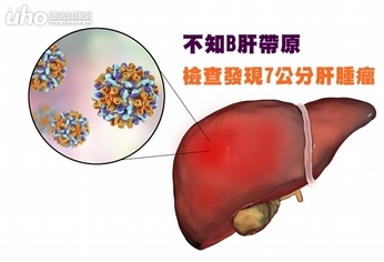 不知B肝帶原 檢查發現7公分肝腫瘤