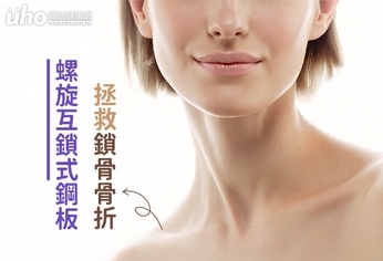 新式「螺旋型互鎖式鋼板」,縮短鎖骨骨折之病程