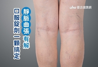 靜脈曲張有解　口服錠劑一顆搞定