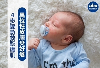 異位性皮膚炎好癢 4步驟急救乾癢肌