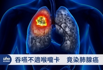 吞嚥不適喉嚨卡 竟染肺腺癌
