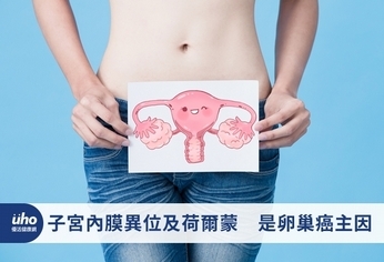 子宮內膜異位及荷爾蒙　是卵巢癌主因