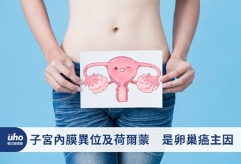 子宮內膜異位及荷爾蒙 是卵巢癌主因