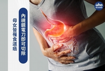 母女皆罹食道癌 內視鏡電刀即可切除