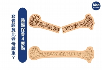 女骨鬆竟比老母嚴重?醫籲保骨4要點