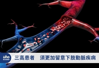 三高患者 須更加留意下肢動脈疾病
