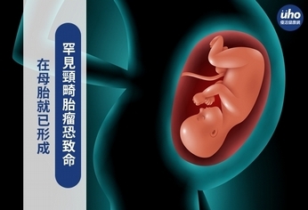 在母胎就已形成 罕見頸畸胎瘤恐致命