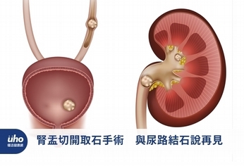 腎盂切開取石手術 與尿路結石說再見
