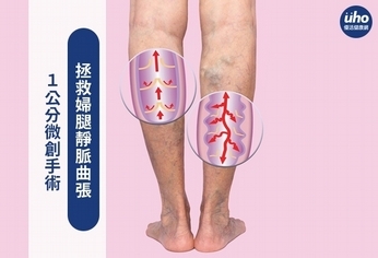 1公分微創手術 拯救婦腿靜脈曲張