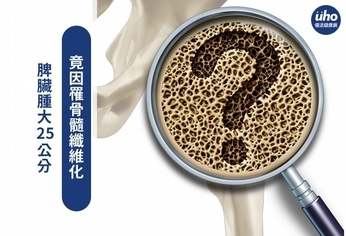 脾臟腫大25公分 竟因罹骨髓纖維化