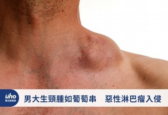 男大生頸腫如葡萄串 惡性淋巴瘤入侵