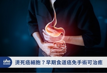 燙死癌細胞?早期食道癌免手術可治癒