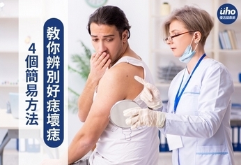 4個簡易方法 教你辨別好痣壞痣