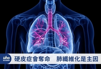 硬皮症會奪命 肺纖維化是主因