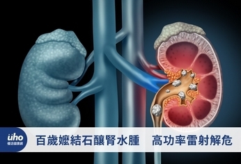 百歲嬤結石釀腎水腫 高功率雷射解危
