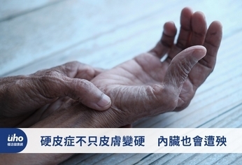 硬皮症不只皮膚變硬 內臟也會遭殃