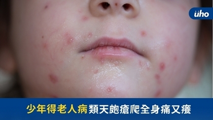 少年得老人病 類天皰瘡爬全身痛又癢