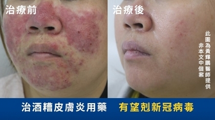 治酒糟皮膚炎用藥 有望剋新冠病毒