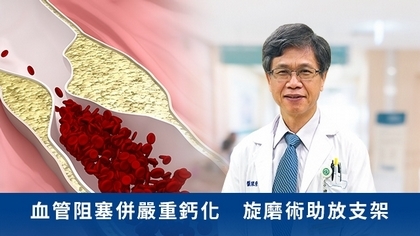 血管阻塞併嚴重鈣化 旋磨術助放支架