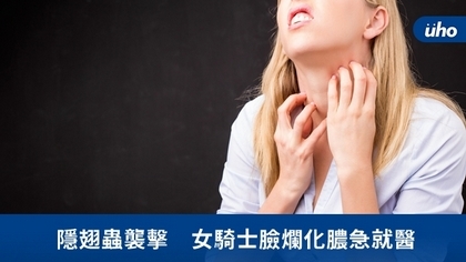 隱翅蟲襲擊 女騎士臉爛化膿急就醫