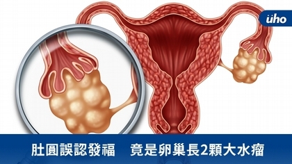 肚圓誤認發福 竟是卵巢長2顆大水瘤