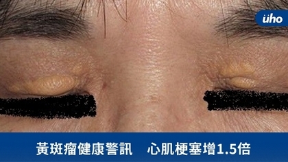 黃斑瘤健康警訊 心肌梗塞增1.5倍