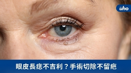 眼皮長痣不吉利?手術切除不留疤