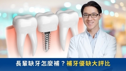 長輩缺牙怎麼補?補牙優缺大評比