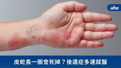 皮蛇長一圈會死掉?後遺症多速就醫