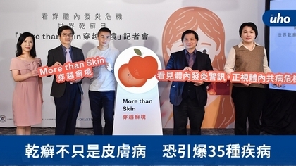 乾癬不只是皮膚病 恐引爆35種疾病