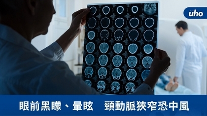 眼前黑矇、暈眩 頸動脈狹窄恐中風
