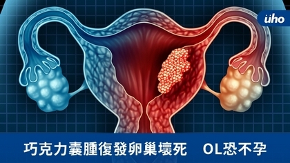 巧克力囊腫復發卵巢壞死 OL恐不孕