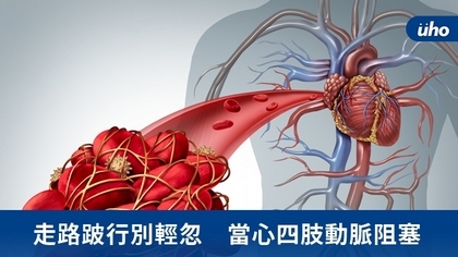 走路跛行別輕忽 當心四肢動脈阻塞