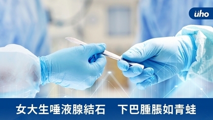 女大生唾液腺結石 下巴腫脹如青蛙