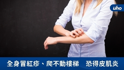 全身冒紅疹、爬不動樓梯 恐得皮肌炎