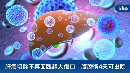 肝癌切除不再面臨超大傷口 腹腔術4天可出院