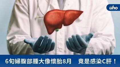 6旬婦腹部腫大像懷胎8月 竟是感染C肝!