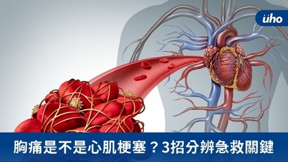 胸痛是不是心肌梗塞?3招分辨急救關鍵