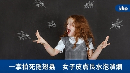 一掌拍死隱翅蟲 女子皮膚長水泡潰爛