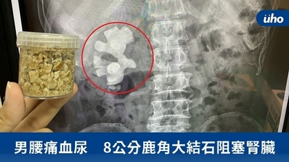 男腰痛血尿 8公分鹿角大結石阻塞腎臟
