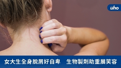 女大生全身脫屑好自卑 生物製劑助重展笑容