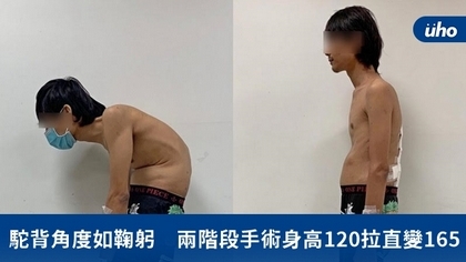 駝背角度如鞠躬 兩階段手術身高120拉直變165