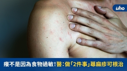 癢不是因為食物過敏!醫:做「2件事」蕁麻疹可根治