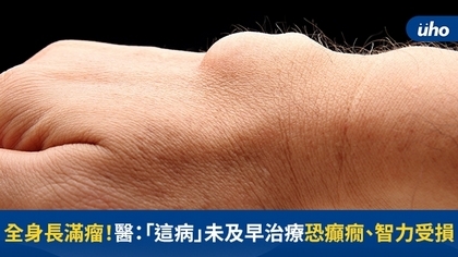 全身長滿瘤!醫:「這病」未及早治療恐癲癇、智力受損