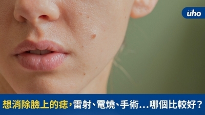 想消除臉上的痣,雷射、電燒、手術⋯哪個比較好?