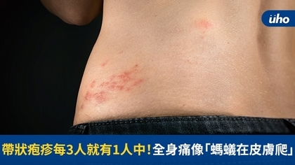 帶狀疱疹每3人就有1人中!全身痛像「螞蟻在皮膚爬」