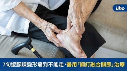 7旬嬤腳踝變形痛到不能走,醫用「鋼釘融合關節」治療