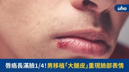 唇癌長滿臉1/4!男移植「大腿皮」重現臉部表情