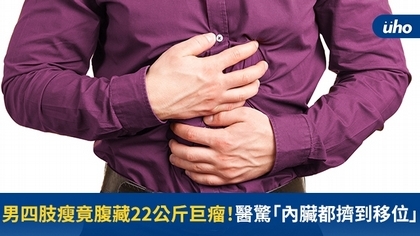 男四肢瘦竟腹藏22公斤巨瘤!醫驚「內臟都擠到移位」