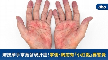 婦按摩手掌竟發現肝癌!掌側、胸前有「小紅點」要警覺